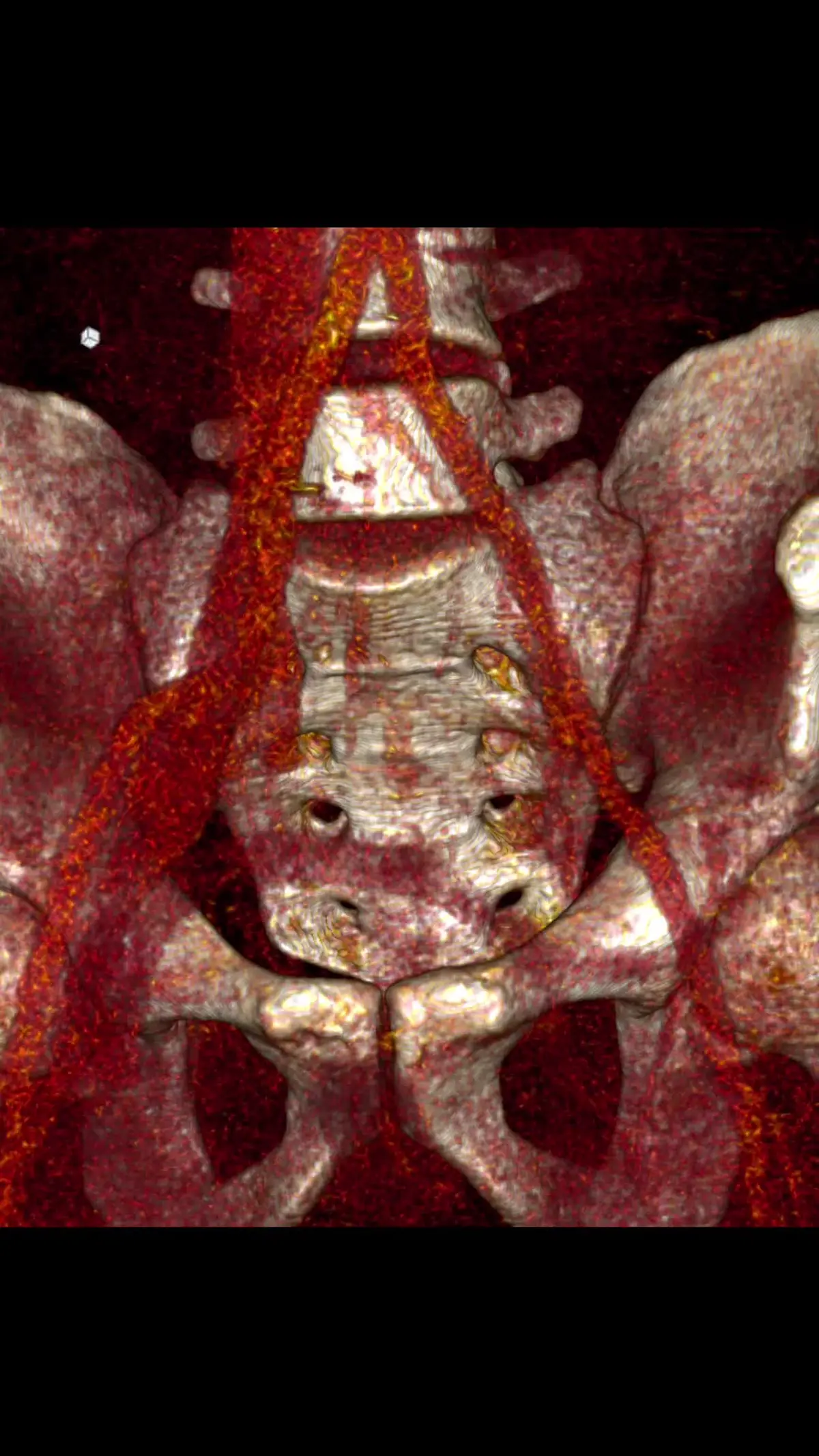 Reconstrução 3D de angiotomografia mostrando a artéria ilíaca comum direita cruzando sobre a veia ilíaca comum esquerda, na frente da coluna
