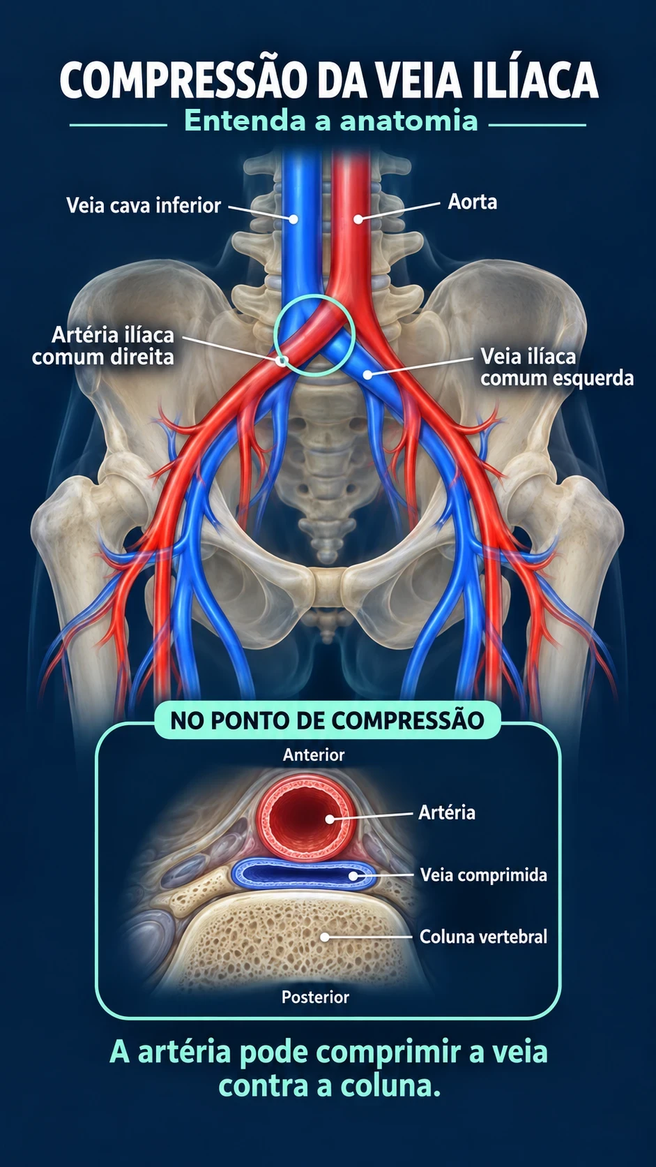 Ilustração anatômica da compressão da veia ilíaca: a artéria ilíaca comum direita cruza por cima da veia ilíaca comum esquerda e a comprime contra a coluna vertebral, com um corte mostrando a veia achatada entre a artéria e a vértebra
