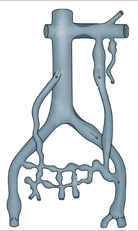 Ilustração anatômica do sistema venoso abdominopélvico, com veia cava, veias renais, ilíacas, gonadais e o plexo pélvico, e setas indicando o sentido do fluxo