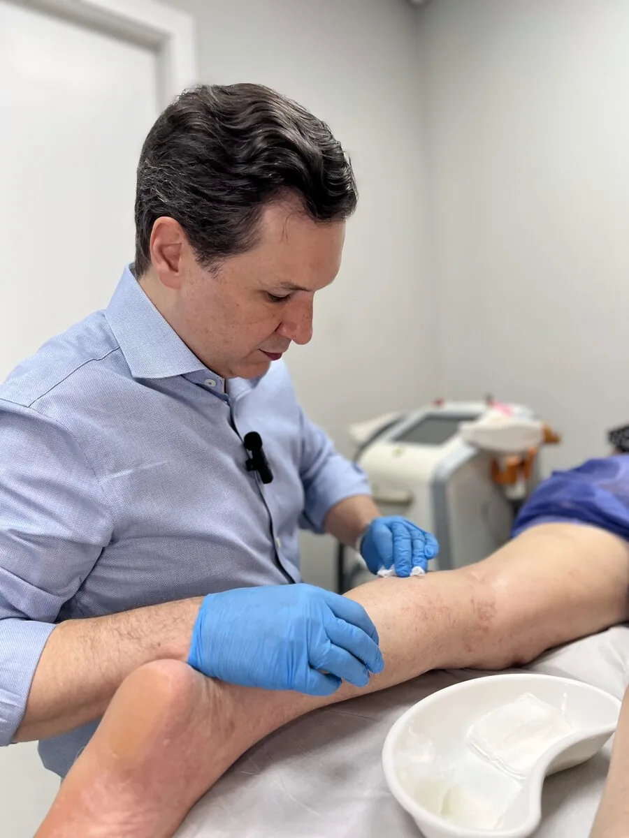 Tratamento: Escleroterapia com Espuma