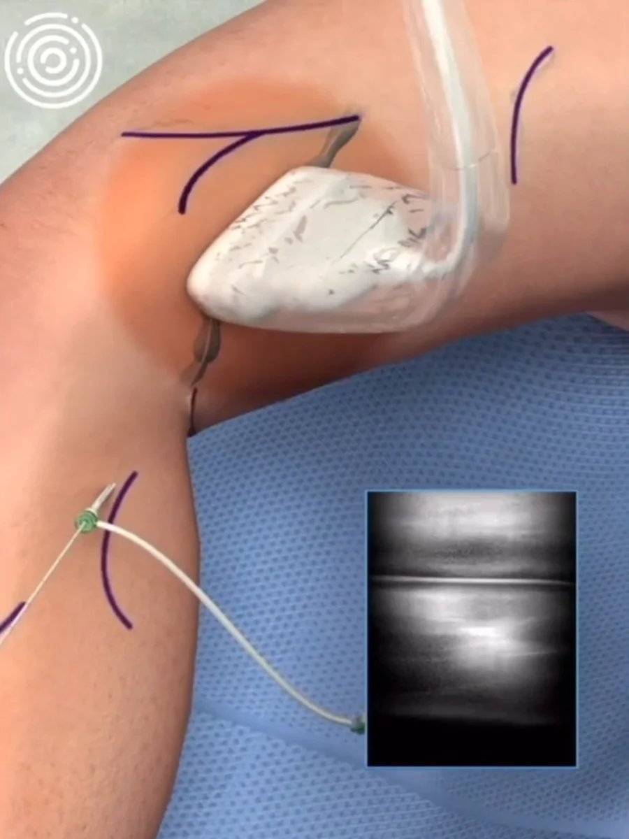 Tratamento: Laser Endovenoso (Endolaser)