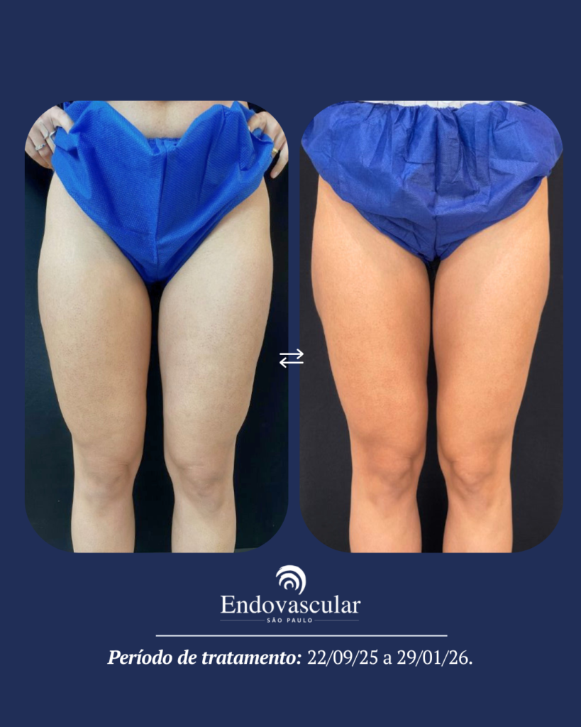 tratamento de lipedema - resultado 4
