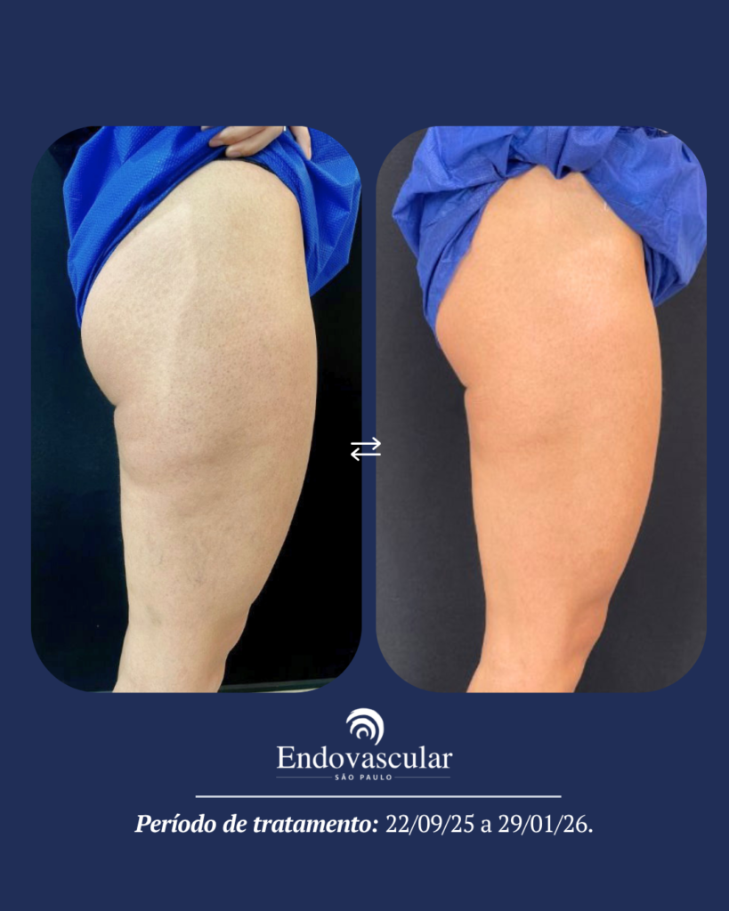 tratamento de lipedema - resultado 2