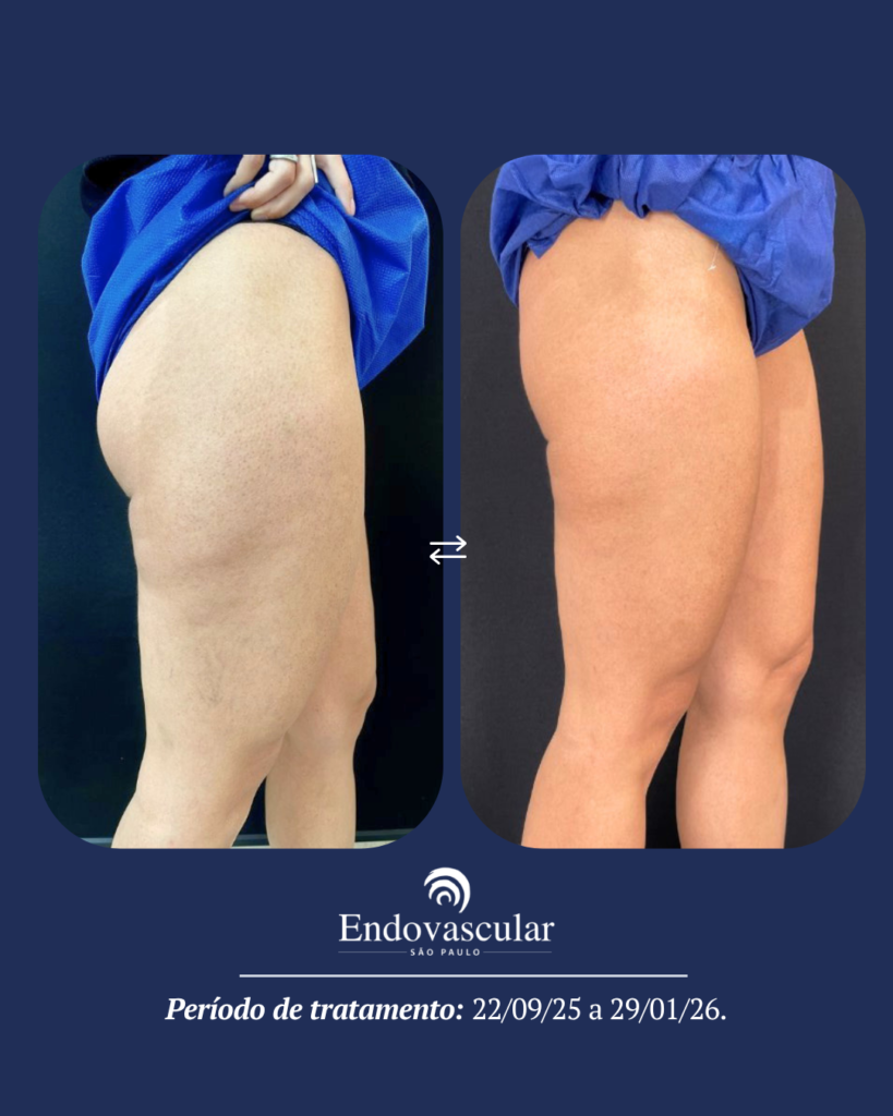 tratamento de lipedema - resultado 1