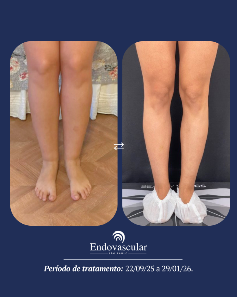 tratamento de lipedema - resultado 3