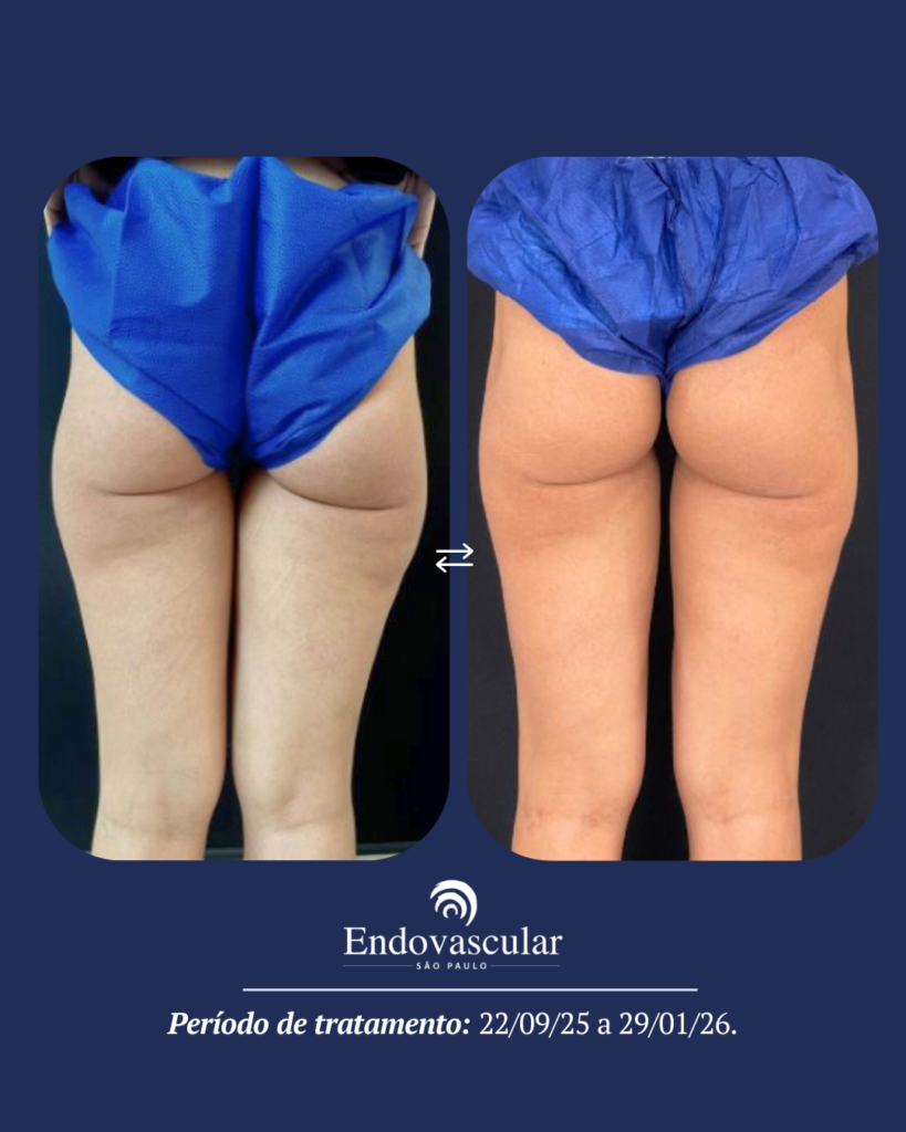 tratamento de lipedema - resultado 5