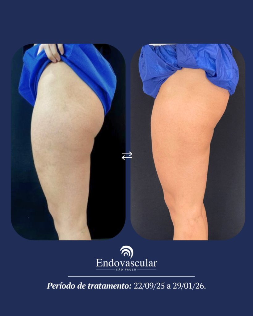 tratamento de lipedema - resultado 5